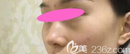 花9800元找景德鎮(zhèn)藝美虞國鋒做假體+半肋骨隆鼻術(shù)前照片 花9800元找景德鎮(zhèn)藝美虞國鋒做假體+半肋骨隆鼻術(shù)前照片