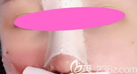 花9800元找景德鎮(zhèn)藝美虞國鋒做假體+半肋骨隆鼻術(shù)后第3天樣子 花9800元找景德鎮(zhèn)藝美虞國鋒做假體+半肋骨隆鼻術(shù)后第3天樣子