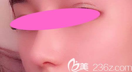 找景德鎮(zhèn)藝美虞國鋒做假體+半肋骨隆鼻術(shù)后第10天效果 找景德鎮(zhèn)藝美虞國鋒做假體+半肋骨隆鼻術(shù)后第10天效果