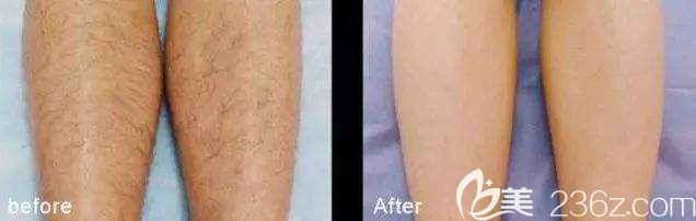 鄭州華領脫毛前后對比照片