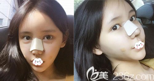 韓國DI醫(yī)院假體隆鼻+鼻尖鼻中隔修復術后3天恢復圖