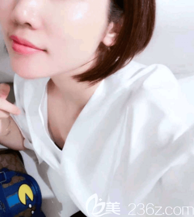 北京藝星面部線雕提升案例 北京藝星面部線雕提升案例