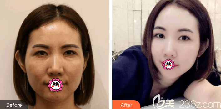 北京藝星慕昕醫(yī)生面部線雕提升案例 北京藝星慕昕醫(yī)生面部線雕提升案例