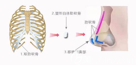 自體肋軟骨隆鼻示意圖