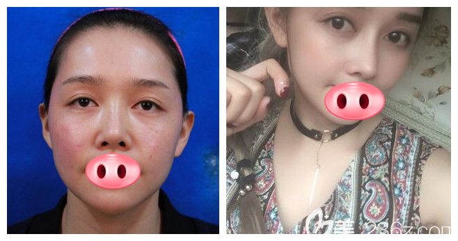 合肥維多利亞衛(wèi)愛俠手術(shù)怎么樣？衛(wèi)院長鼻綜合隆鼻案例效果驗(yàn)證