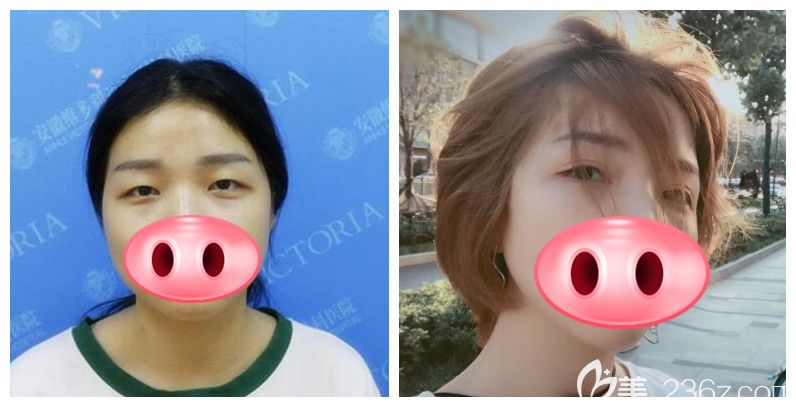 徐和林院長擅長做什么？來看維多利亞徐和林院長眼綜合案例前后對(duì)比效果