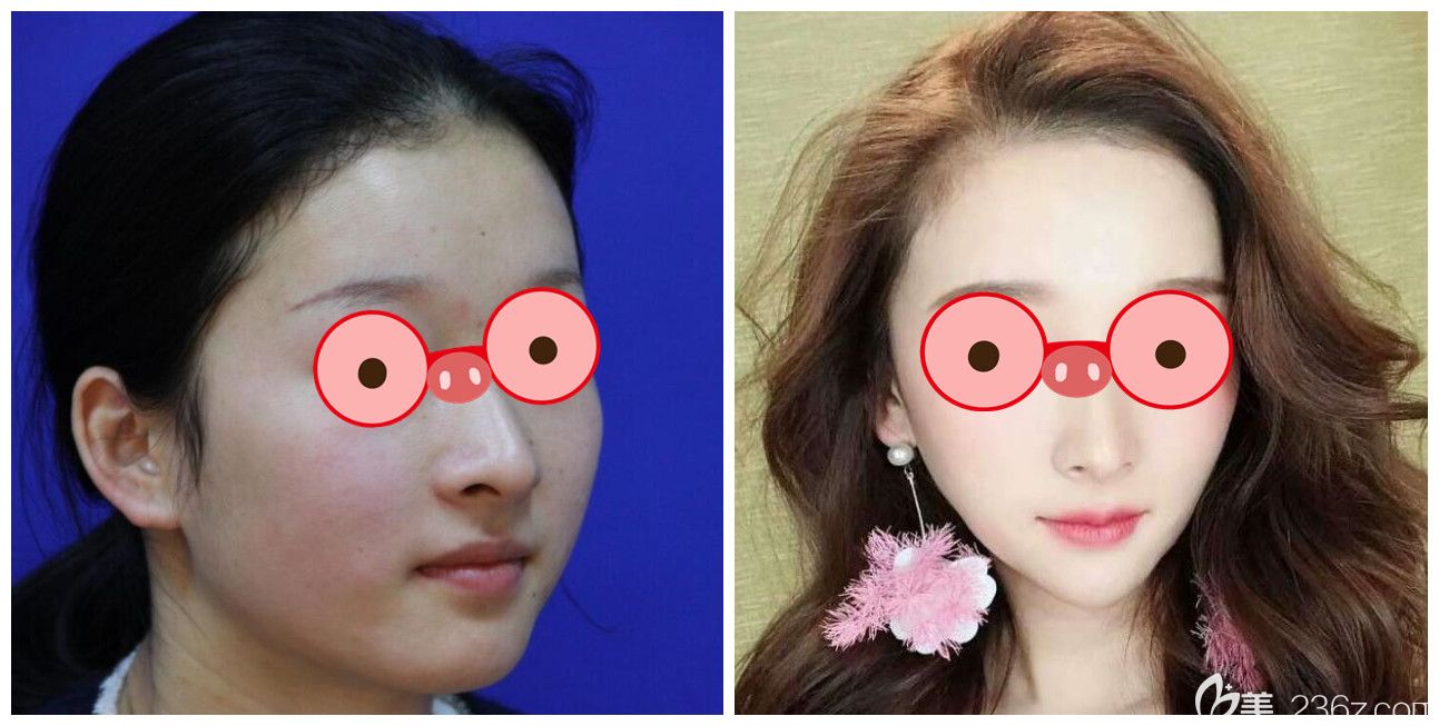 合肥維多利亞張靜瘦臉案例前后效果對(duì)比照片