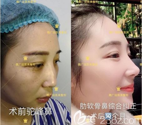 蘭州韓美整形自體肋軟骨鼻綜合隆鼻案例