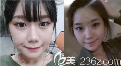 必嫵整形醫(yī)院尹昶云輪廓真人案例