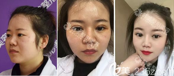 天水韓美石正平全切雙眼皮+開(kāi)眼角術(shù)前、第三天、20天對(duì)比照片