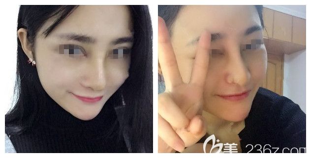 術后一周到南通維多利亞拆線鼻子恢復