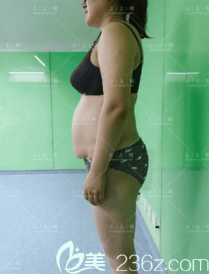 在北京上上相做腰腹吸脂前側面樣子