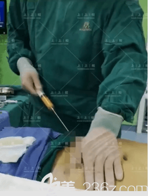 侯月華醫(yī)生給我做腰腹吸脂當天手術照