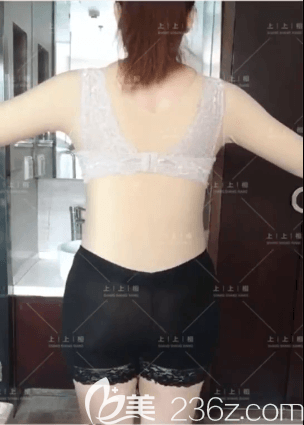 北京上上相醫(yī)療美容腰腹吸脂案例