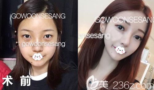 韓國李炳澮隆鼻修復(fù)案例前后效果對比圖