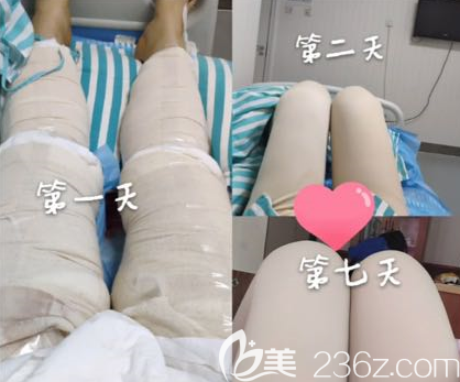 吸脂手術(shù)第1天和第二天還有第七天的樣子