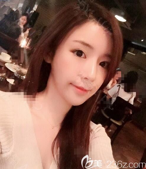 JJ洪鎮(zhèn)柱整形梁海元透明顴骨縮小術眼鼻部手術脂肪移植后收獲了娃娃臉