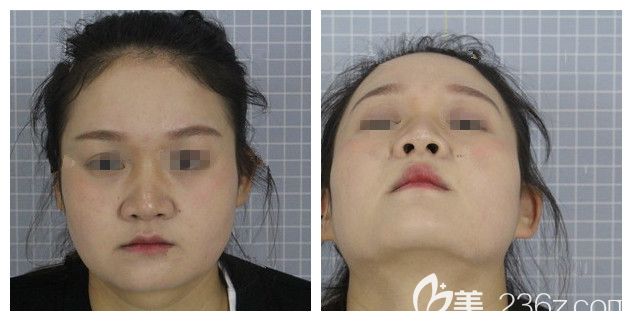 面診常州美貝爾術(shù)前的我塌鼻子大圓臉 面診常州美貝爾術(shù)前的我塌鼻子大圓臉
