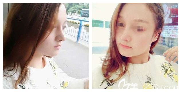 做完鼻綜合+瘦臉術(shù)后一周<span style= 做完鼻綜合+瘦臉術(shù)后一周<span style=