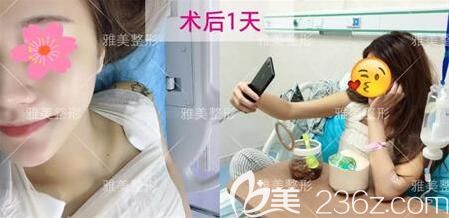 在雅美做假體隆胸術(shù)后1天效果 在雅美做假體隆胸術(shù)后1天效果