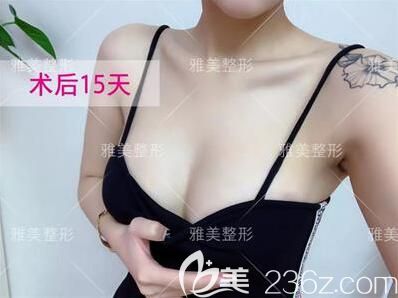 在雅美做完假體隆胸術(shù)后15天恢復(fù)效果 在雅美做完假體隆胸術(shù)后15天恢復(fù)效果