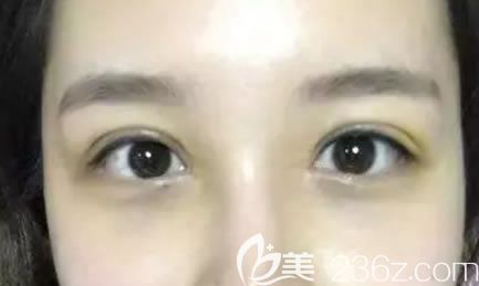 做雙眼皮修復(fù)手術(shù)7天恢復(fù)圖 做雙眼皮修復(fù)手術(shù)7天恢復(fù)圖