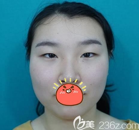 在江浙義烏陽光醫(yī)院做雙眼皮前 在江浙義烏陽光醫(yī)院做雙眼皮前