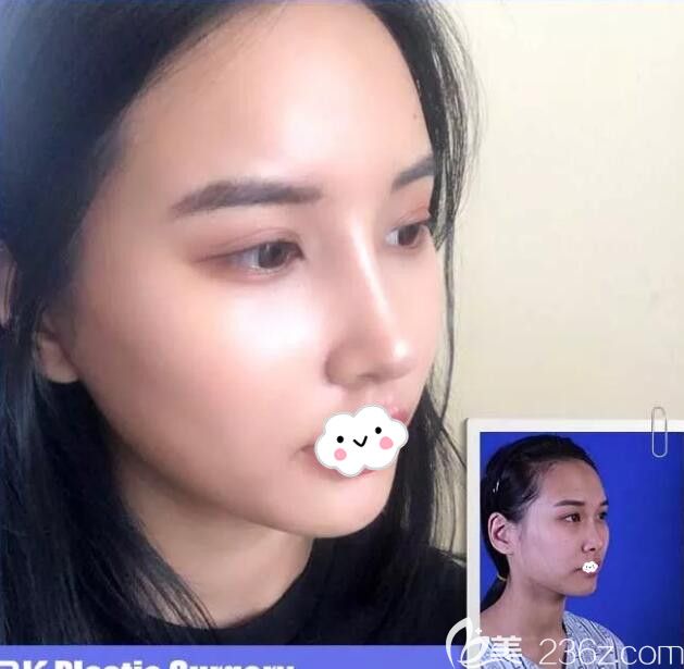 韓國BK整形醫(yī)院假體隆鼻+脂肪填充全臉案例術(shù)后恢復(fù)圖