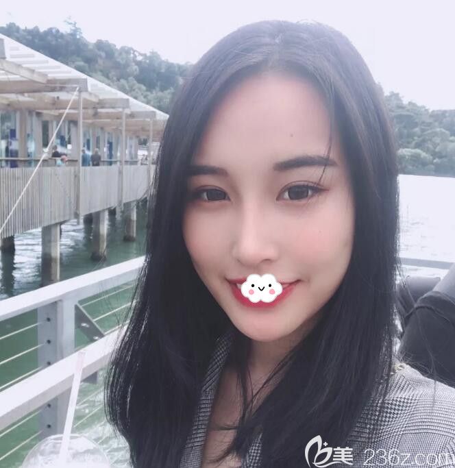 韓國BK整形醫(yī)院做鼻綜合隆鼻+PRP自體脂肪面部填充1個月的美麗邂逅