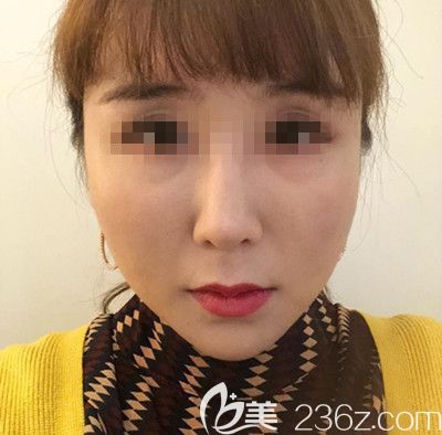 在韓國寶士麗做埋線手術前 在韓國寶士麗做埋線手術前