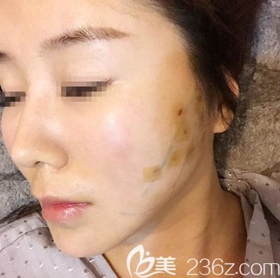 在韓國寶士麗做埋線手術第1天 在韓國寶士麗做埋線手術第1天