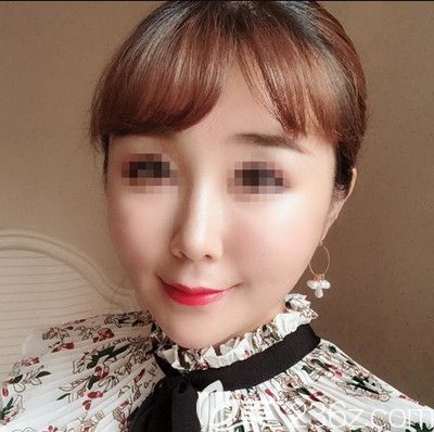 在韓國寶士麗做埋線手術后5天 在韓國寶士麗做埋線手術后5天