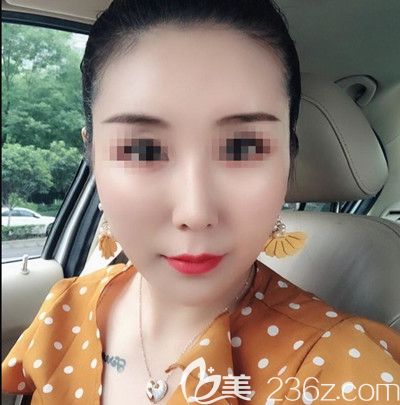 在韓國寶士麗做埋線手術后1個月 在韓國寶士麗做埋線手術后1個月