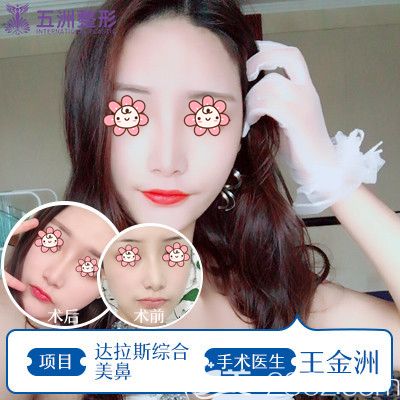 五洲萊美王金洲醫(yī)生做達(dá)拉斯鼻綜合術(shù)后效果