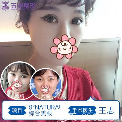 王志做綜合美眼術(shù)術(shù)前術(shù)后對比圖