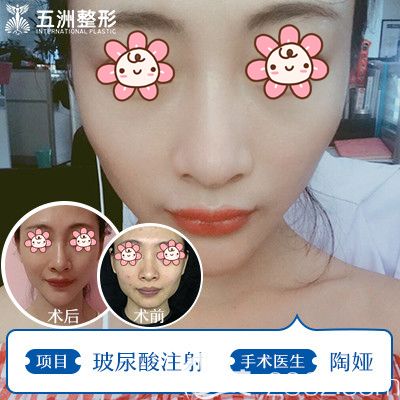 陶婭醫(yī)生面部注射玻尿酸改善面部凹陷效果