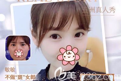 超皮秒祛斑術(shù)前術(shù)后對比