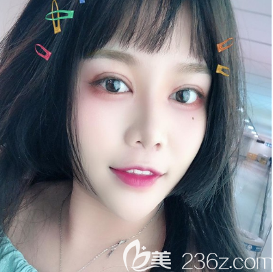 用我的親身經歷告訴你深圳米蘭柏羽朱武根雙眼皮修復做得怎么樣