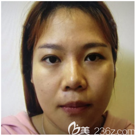 在深圳米蘭柏羽做雙眼皮修復(fù)術(shù)前照片 在深圳米蘭柏羽做雙眼皮修復(fù)術(shù)前照片