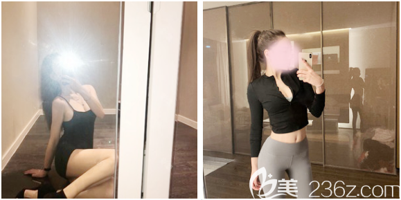 腰腹環(huán)吸術(shù)后恢復(fù)過程圖片 腰腹環(huán)吸術(shù)后恢復(fù)過程圖片