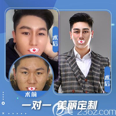 石家莊藍(lán)山隆鼻手術(shù)案例