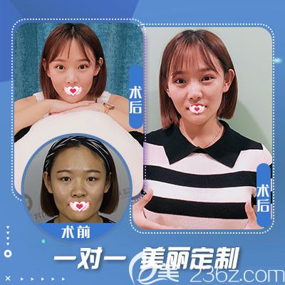 藍(lán)山整形醫(yī)院做雙眼皮手術(shù)案例