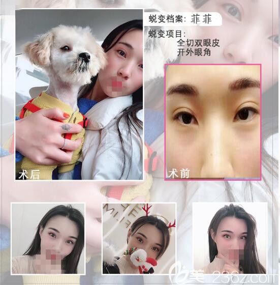 鄭州菲林雙眼皮手術前后對比照片