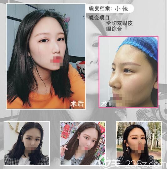 鄭州菲林雙眼皮手術前后對比照片