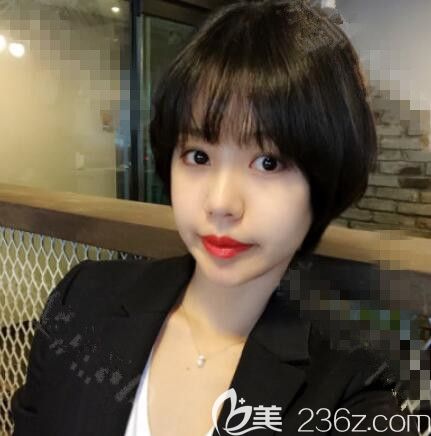 那木整形醫(yī)院隆鼻真人案例