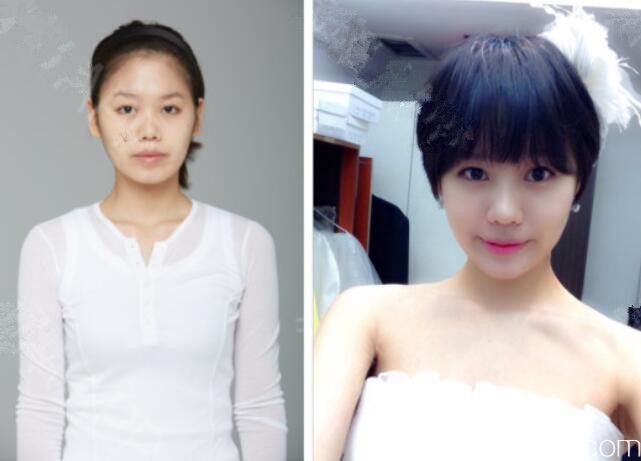 那木整形醫(yī)院輪廓真人案例