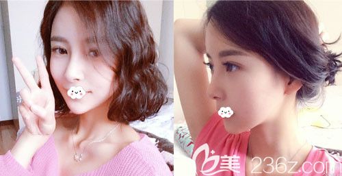 都知道韓國麥恩李圣郁醫(yī)生隆胸很出名，看我做的面部輪廓+額頭縮小術(shù)+雙眼皮效果怎么樣