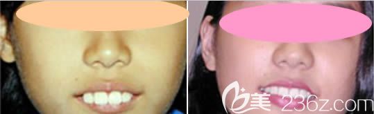 沈陽百嘉麗牙科青少年牙齒矯正效果圖 沈陽百嘉麗牙科青少年牙齒矯正效果圖