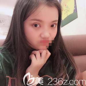 全切雙眼皮術后7天