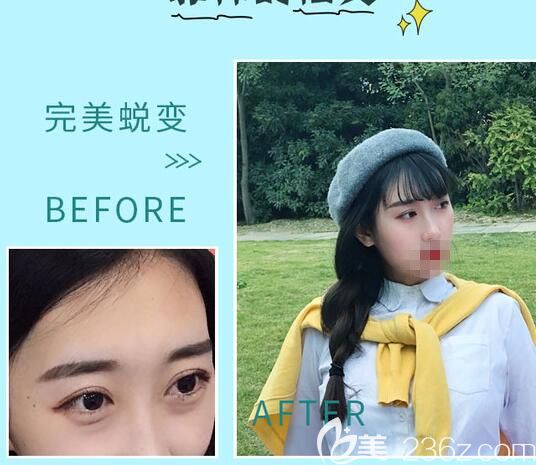 駱豫醫(yī)生顧客 祛眼袋手術前后對比照片